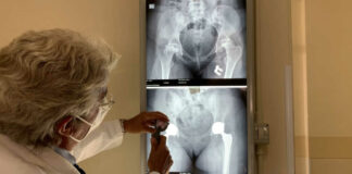 Costretta sulla sedia a rotelle dalla chemioterapia, ragazzina malata di leucemia operata all’anca: potrà tornare a camminare